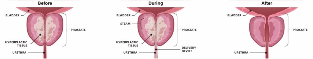 Enlarged Prostate/BPH | Carolina Urology Partners