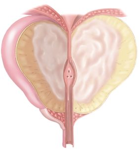 BPH - Enlarged Prostate