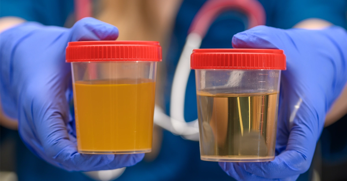 Cloudy Urine Female