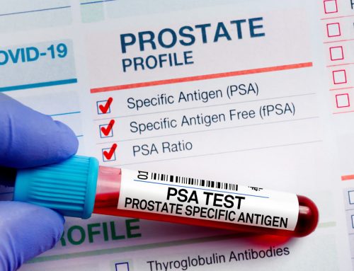What Is a PSA Test? Urology FAQ